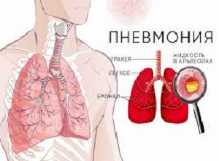 Важно знать, как начинается пневмония