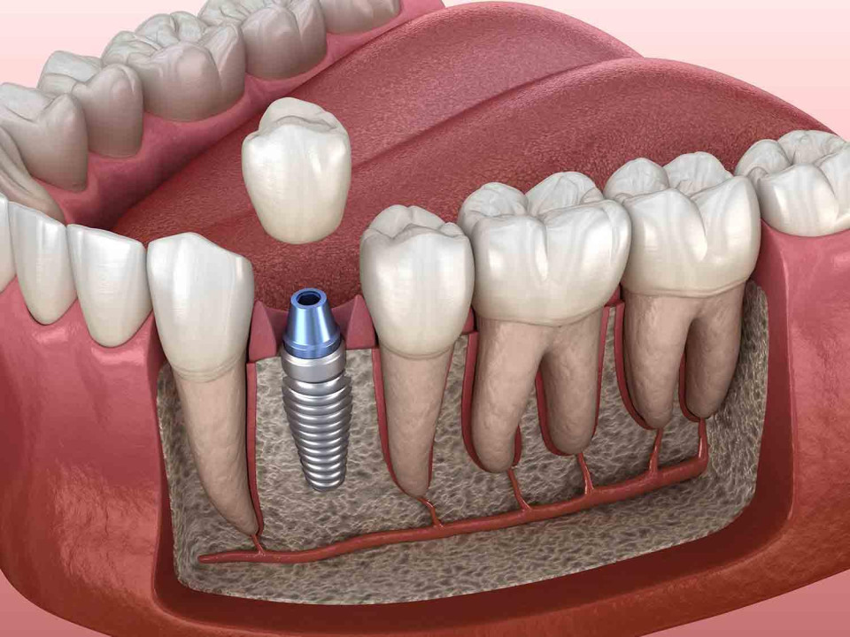 Противопоказания к имплантации зубов (абсолютные, относительные) – кому и  почему нельзя ставить импланты