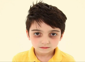 Причины темных кругов под глазами у ребенка