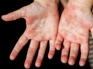 На Чернігівщині двоє дітей померли від скарлатини